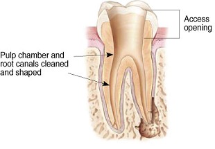Cleaning and shaping a root canal illustration