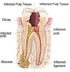 Inflamed and infected tooth illustration